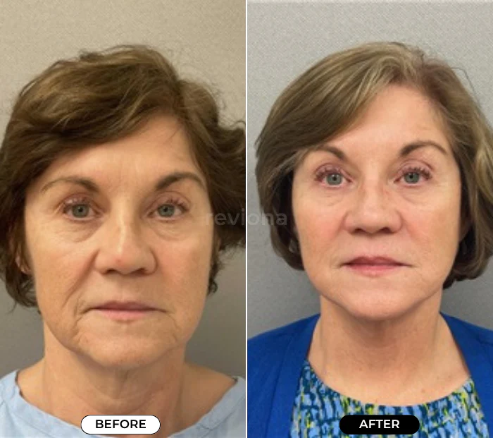 4-in-1 Face Massager